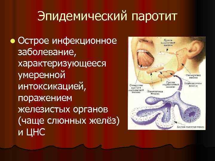 Эпидемический паротит l Острое инфекционное заболевание, характеризующееся умеренной интоксикацией, поражением железистых органов (чаще слюнных