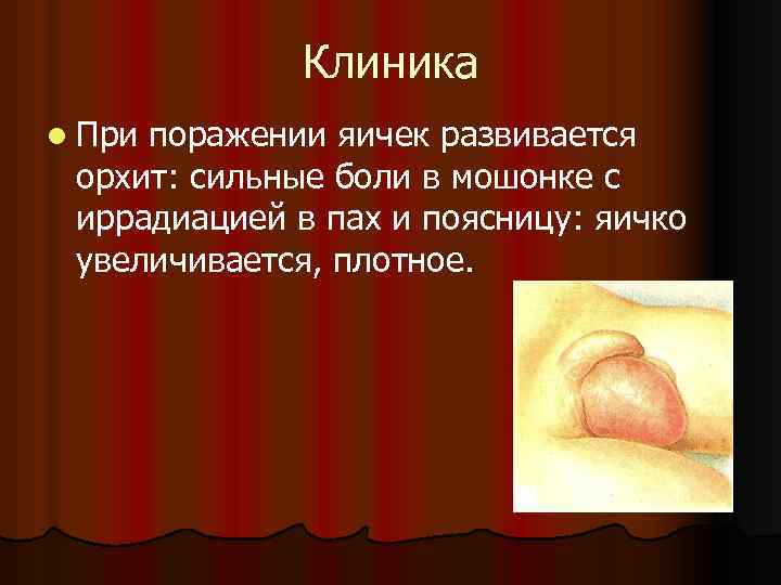 Клиника l При поражении яичек развивается орхит: сильные боли в мошонке с иррадиацией в