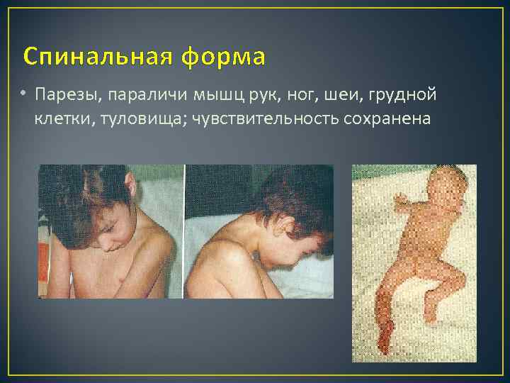 Спинальная форма • Парезы, параличи мышц рук, ног, шеи, грудной клетки, туловища; чувствительность сохранена