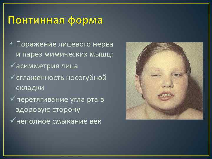 Понтинная форма • Поражение лицевого нерва и парез мимических мышц: üасимметрия лица üсглаженность носогубной