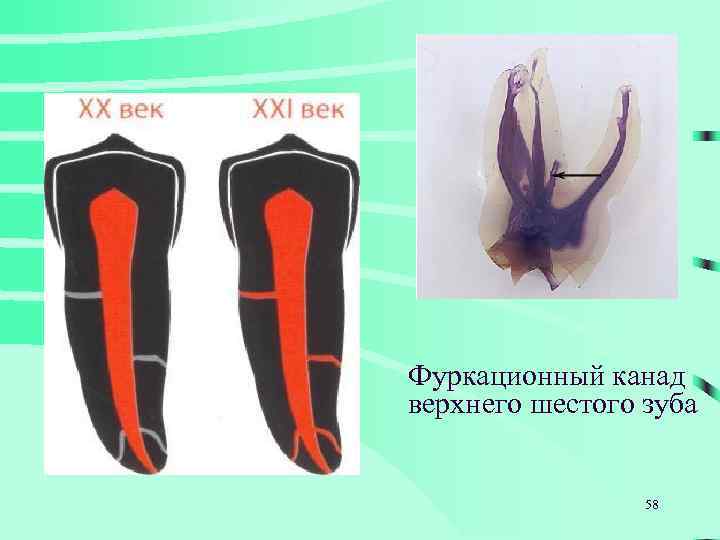 Фуркационный канад верхнего шестого зуба 58 