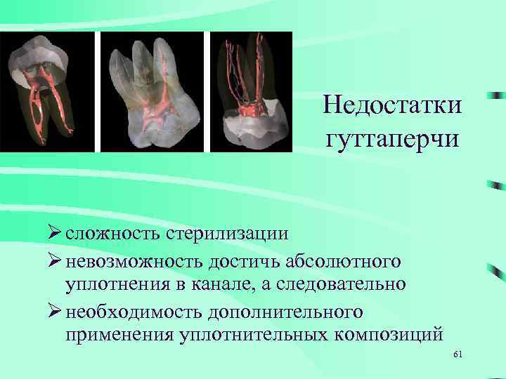 Недостатки гуттаперчи Ø сложность стерилизации Ø невозможность достичь абсолютного уплотнения в канале, а следовательно