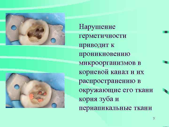 Нарушение герметичности приводит к проникновению микроорганизмов в корневой канал и их распространению в окружающие