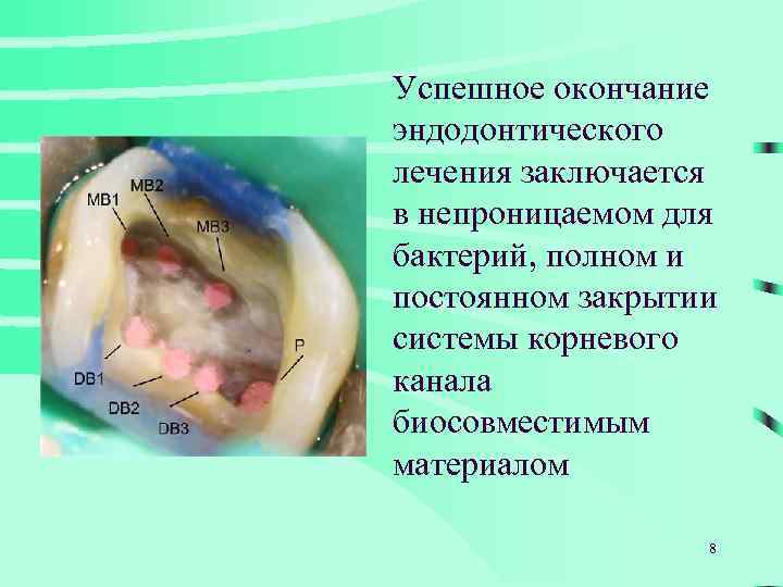 Успешное окончание эндодонтического лечения заключается в непроницаемом для бактерий, полном и постоянном закрытии системы