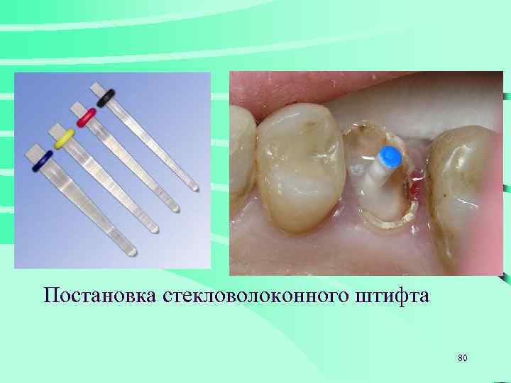 Постановка стекловолоконного штифта 80 