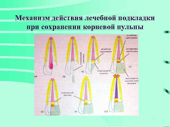 Механизм действия лечебной подкладки при сохранении корневой пульпы 18 