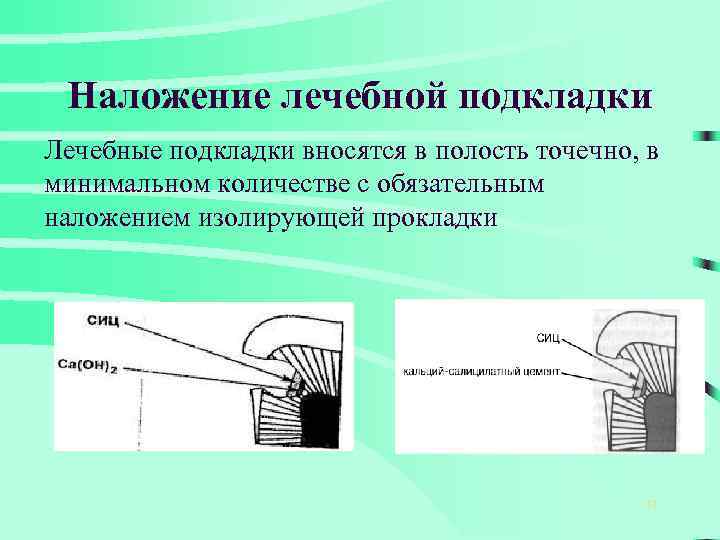 Схема наложения лечебных прокладок