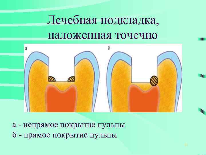 Лечебная подкладка, наложенная точечно а - непрямое покрытие пульпы б - прямое покрытие пульпы