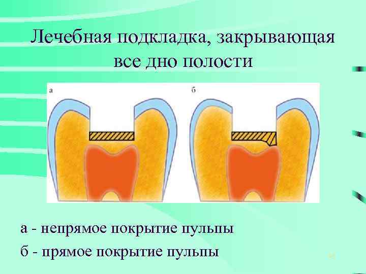 Лечебная подкладка, закрывающая все дно полости а - непрямое покрытие пульпы б - прямое