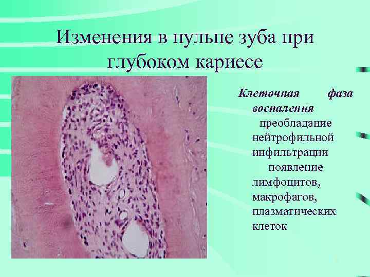 Изменения в пульпе зуба при глубоком кариесе Клеточная фаза воспаления преобладание нейтрофильной инфильтрации появление