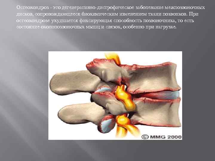 Остеохондроз - это дегенеративно-дистрофическое заболевание межпозвоночных дисков, сопровождающееся биохимическим изменением ткани позвонков. При остеохондрозе