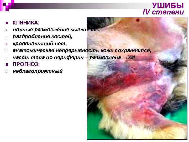 УШИБЫ IV степени n ь ь ь n ь КЛИНИКА: полные размозжение мягких тк.