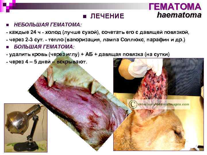 ГЕМАТОМА n ЛЕЧЕНИЕ haematoma НЕБОЛЬШАЯ ГЕМАТОМА: - каждые 24 ч - холод (лучше сухой),