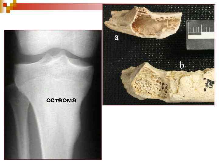 остеома 