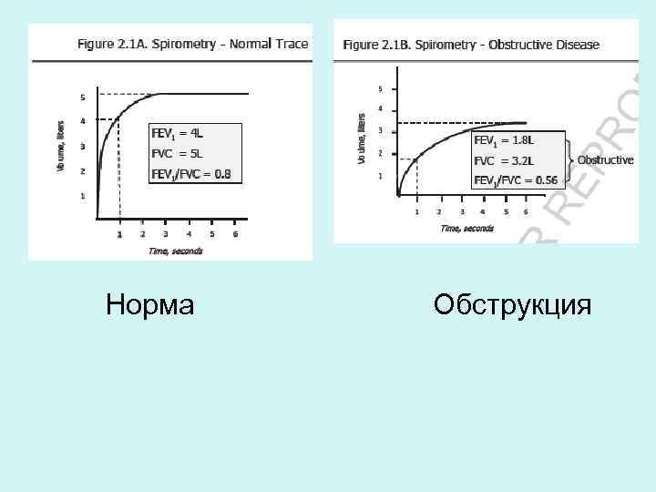 Норма Обструкция 