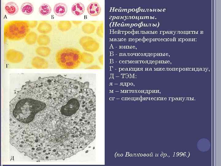 Нейтрофильные гранулоциты. (Нейтрофилы) Нейтрофильные гранулоциты в мазке переферической крови: А - юные, Б -