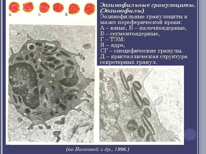 Эозинофильные гранулоциты. (Эозинофилы) Эозинофильные гранулоциты в мазке переферической крови: А – юные, Б –