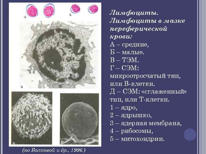 Лимфоциты в мазке переферической крови: А – средние, Б – малые. В – ТЭМ.