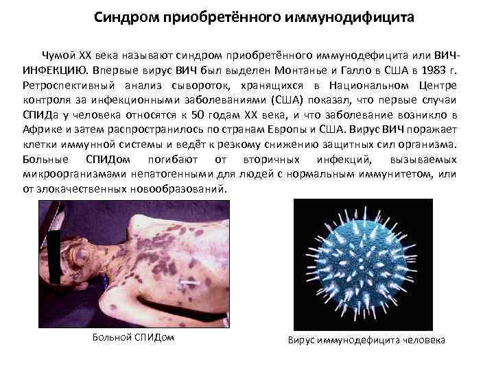 Синдром приобретённого иммунодифицита Чумой ХХ века называют синдром приобретённого иммунодефицита или ВИЧИНФЕКЦИЮ. Впервые вирус
