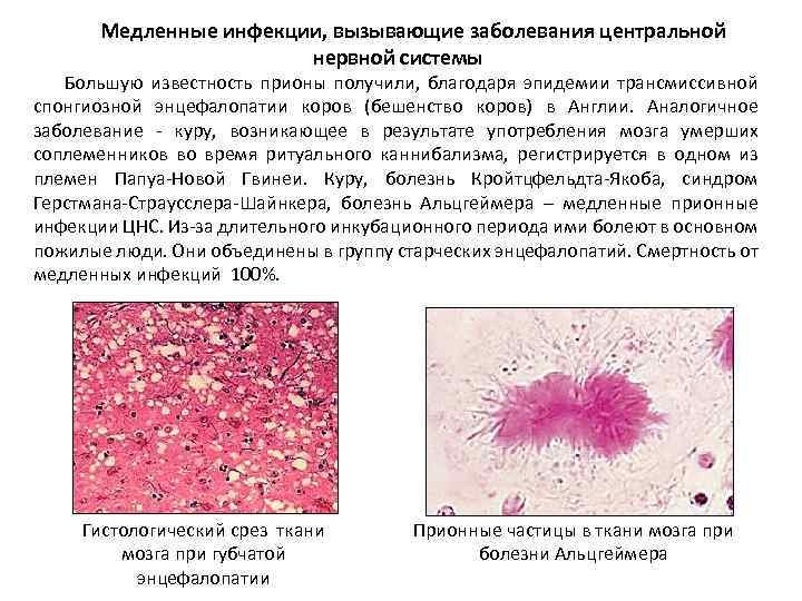 Медленные инфекции, вызывающие заболевания центральной нервной системы Большую известность прионы получили, благодаря эпидемии трансмиссивной