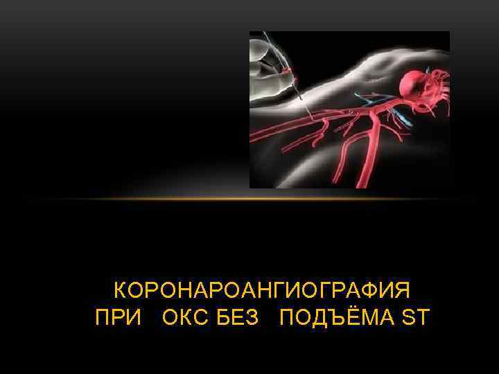 КОРОНАРОАНГИОГРАФИЯ ПРИ ОКС БЕЗ ПОДЪЁМА ST 