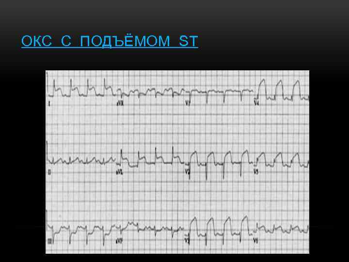 ОКС С ПОДЪЁМОМ ST 