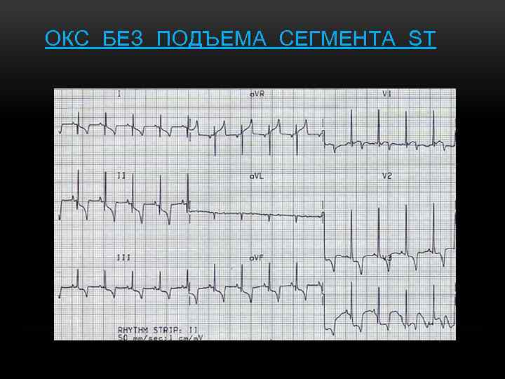 ОКС БЕЗ ПОДЪЕМА СЕГМЕНТА ST 