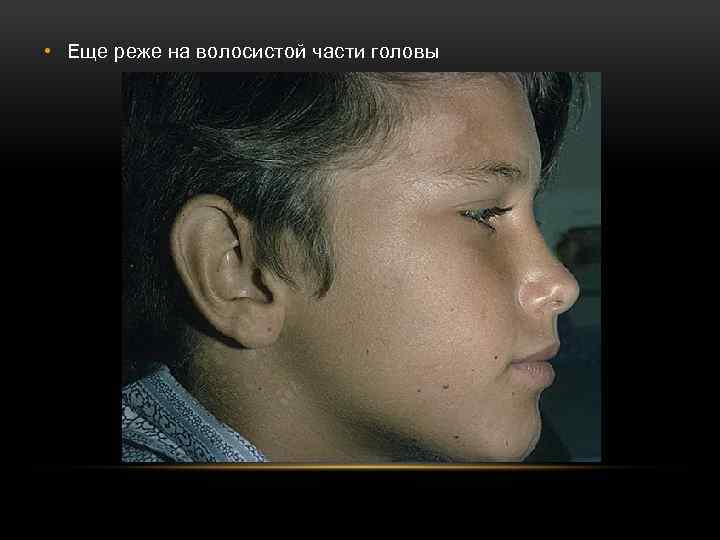  • Еще реже на волосистой части головы 