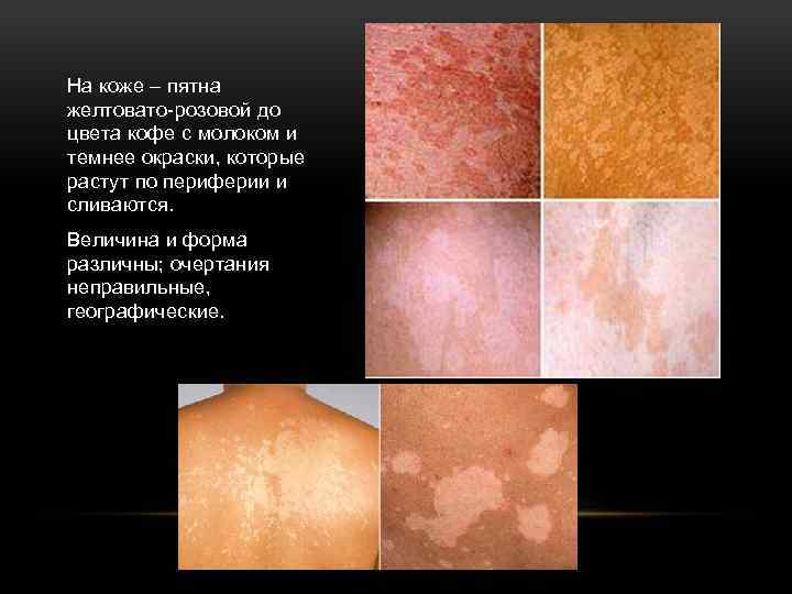 На коже – пятна желтовато-розовой до цвета кофе с молоком и темнее окраски, которые