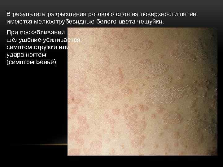 В результате разрыхления рогового слоя на поверхности пятен имеются мелкоотрубевидные белого цвета чешуйки. При