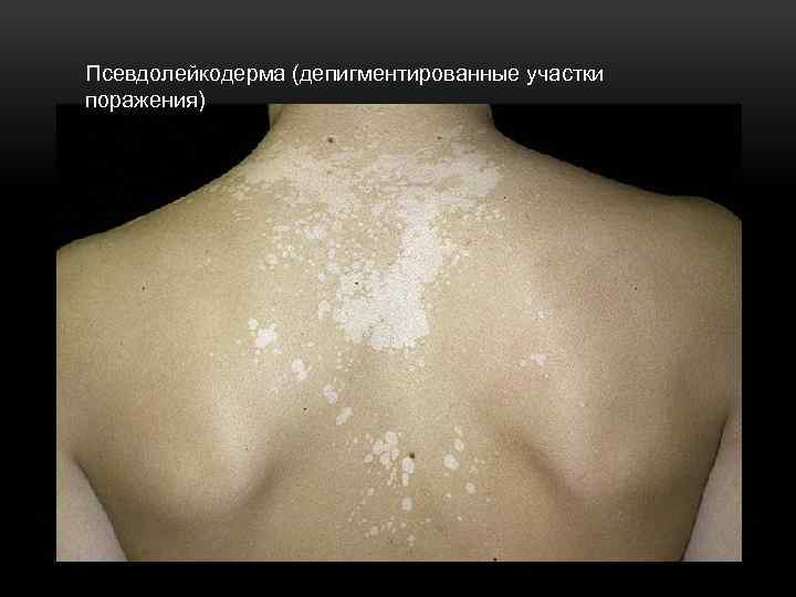 Псевдолейкодерма (депигментированные участки поражения) 