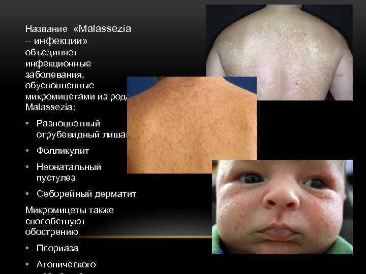 Название «Malassezia – инфекции» объединяет инфекционные заболевания, обусловленные микромицетами из рода Malassezia: • Разноцветный