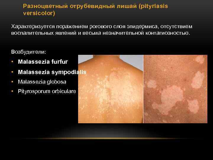 Разноцветный отрубевидный лишай (pityriasis versicolor) Характеризуется поражением рогового слоя эпидермиса, отсутствием воспалительных явлений и
