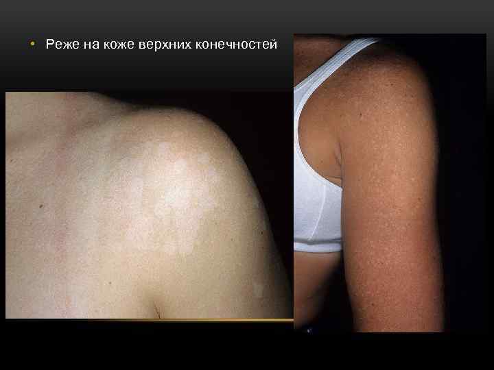  • Реже на коже верхних конечностей 