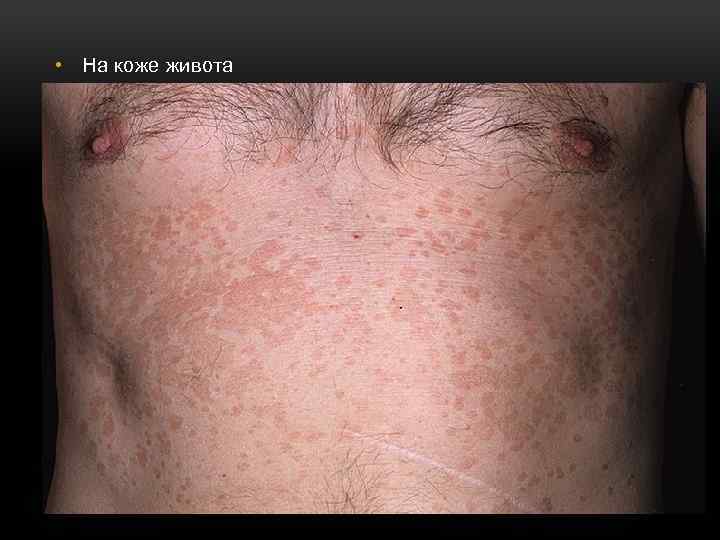  • На коже живота 