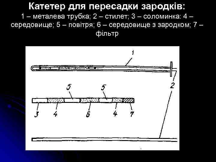 Катетер для пересадки зародків: 1 – металева трубка; 2 – стилет; 3 – соломинка: