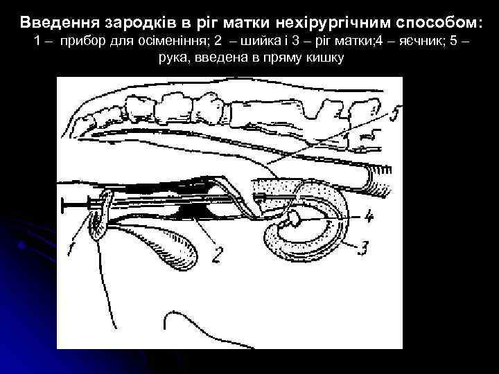 Введення зародків в ріг матки нехірургічним способом: 1 – прибор для осіменіння; 2 –