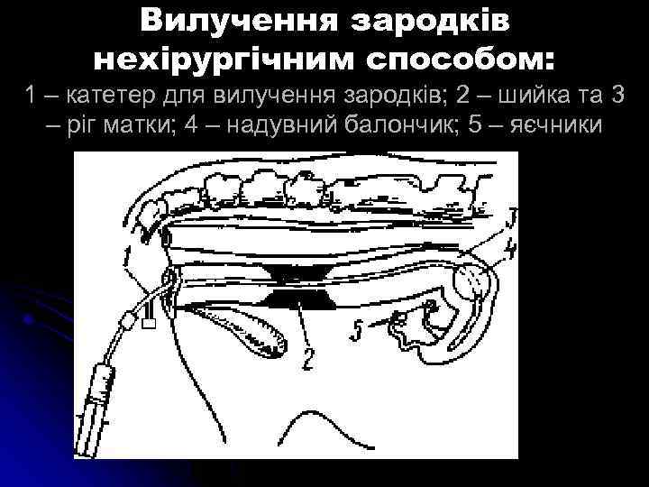 Вилучення зародків нехірургічним способом: 1 – катетер для вилучення зародків; 2 – шийка та