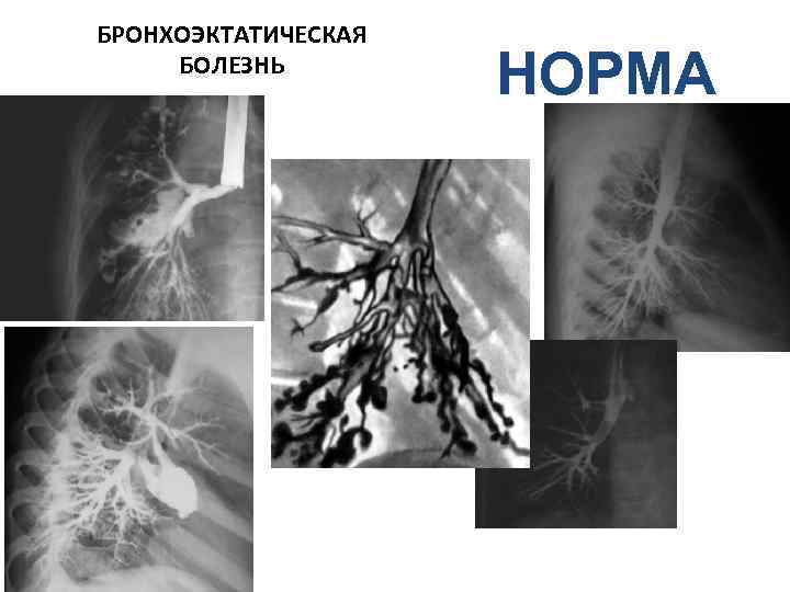БРОНХОЭКТАТИЧЕСКАЯ БОЛЕЗНЬ НОРМА 