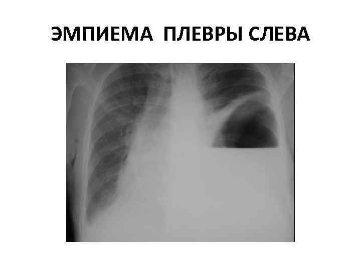 ЭМПИЕМА ПЛЕВРЫ СЛЕВА 