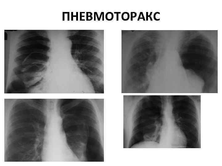 ПНЕВМОТОРАКС 