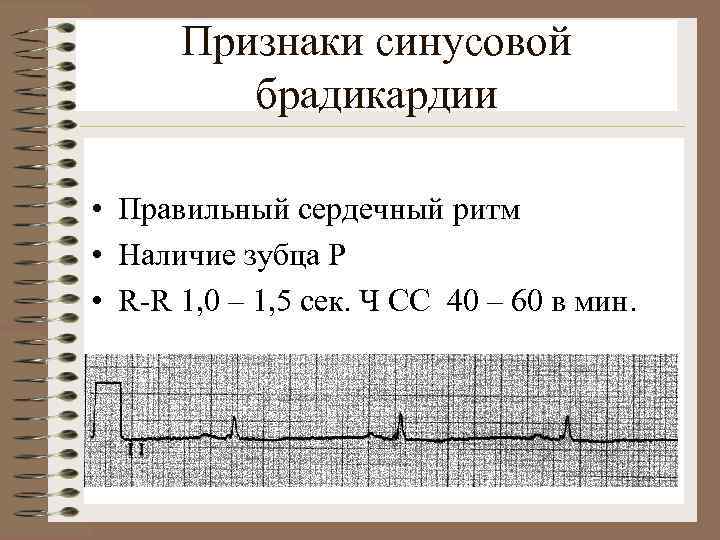 Признаки синусовой брадикардии • Правильный сердечный ритм • Наличие зубца Р • R-R 1,