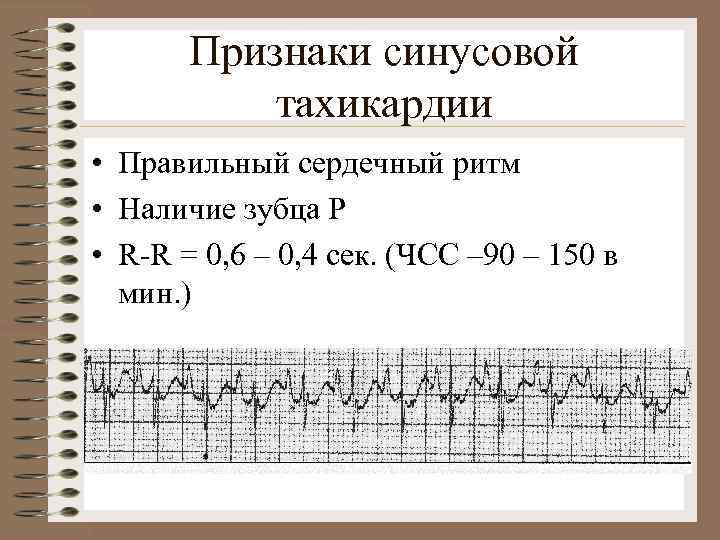 Признаки синусовой тахикардии • Правильный сердечный ритм • Наличие зубца Р • R-R =