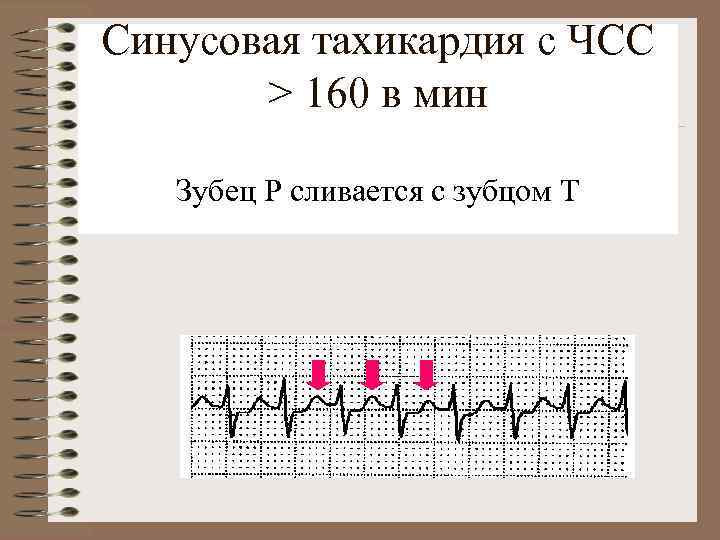 Синусовая тахикардия с ЧСС > 160 в мин Зубец Р сливается с зубцом Т