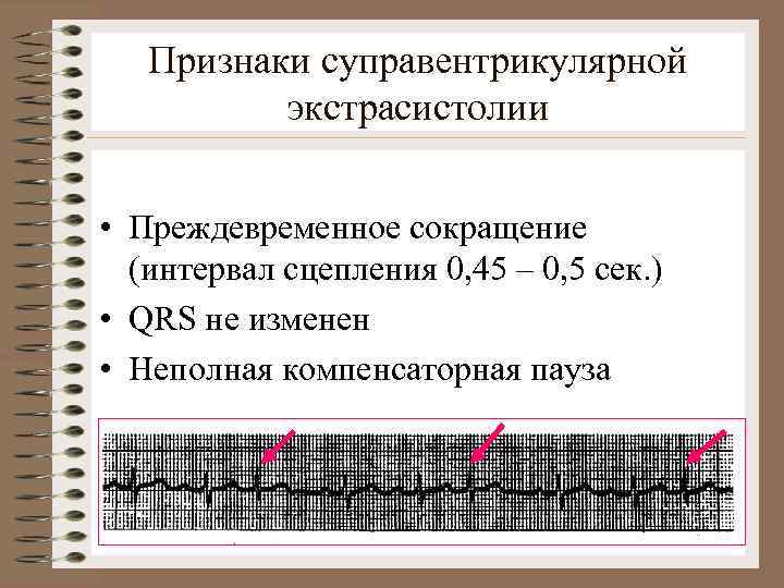 Признаки суправентрикулярной экстрасистолии • Преждевременное сокращение (интервал сцепления 0, 45 – 0, 5 сек.