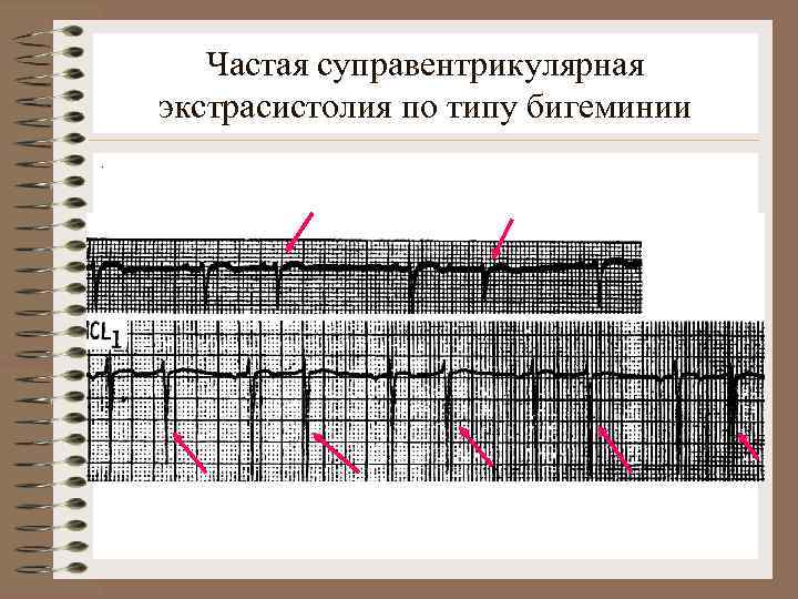 Частая суправентрикулярная экстрасистолия по типу бигеминии. 