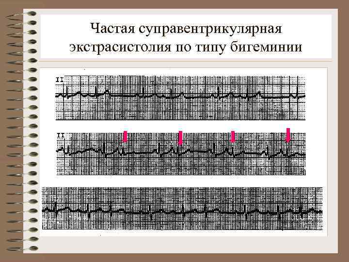 Частая суправентрикулярная экстрасистолия по типу бигеминии. . 