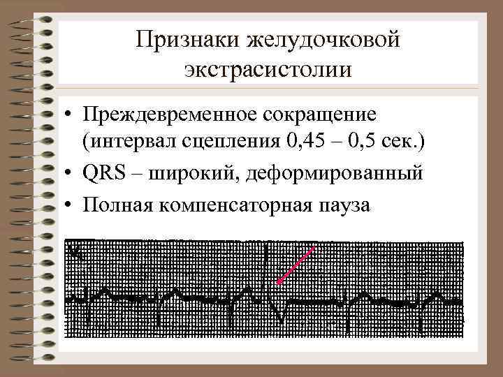 Признаки желудочковой экстрасистолии • Преждевременное сокращение (интервал сцепления 0, 45 – 0, 5 сек.