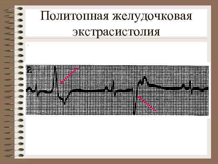 Политопная желудочковая экстрасистолия. 