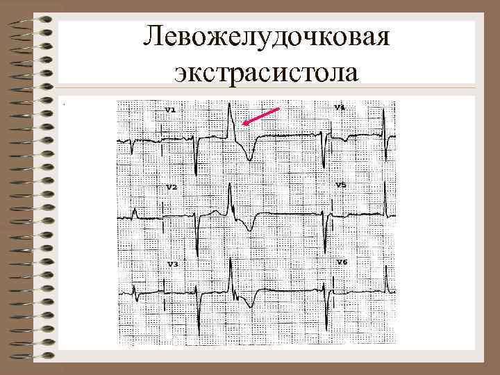 Левожелудочковая экстрасистола. 